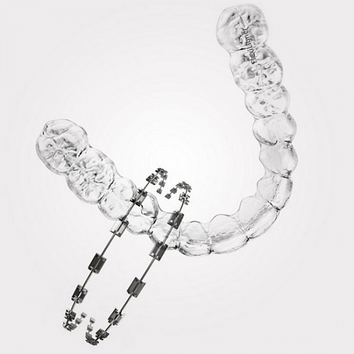 Преимущества элайнеров