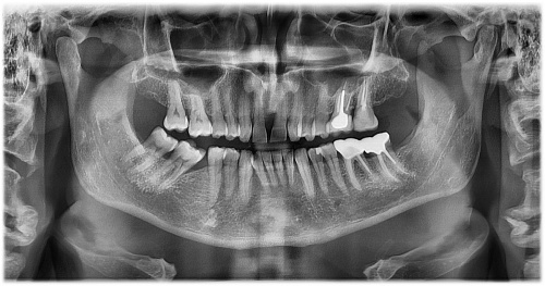 Ортопантомография (панорамный снимок)